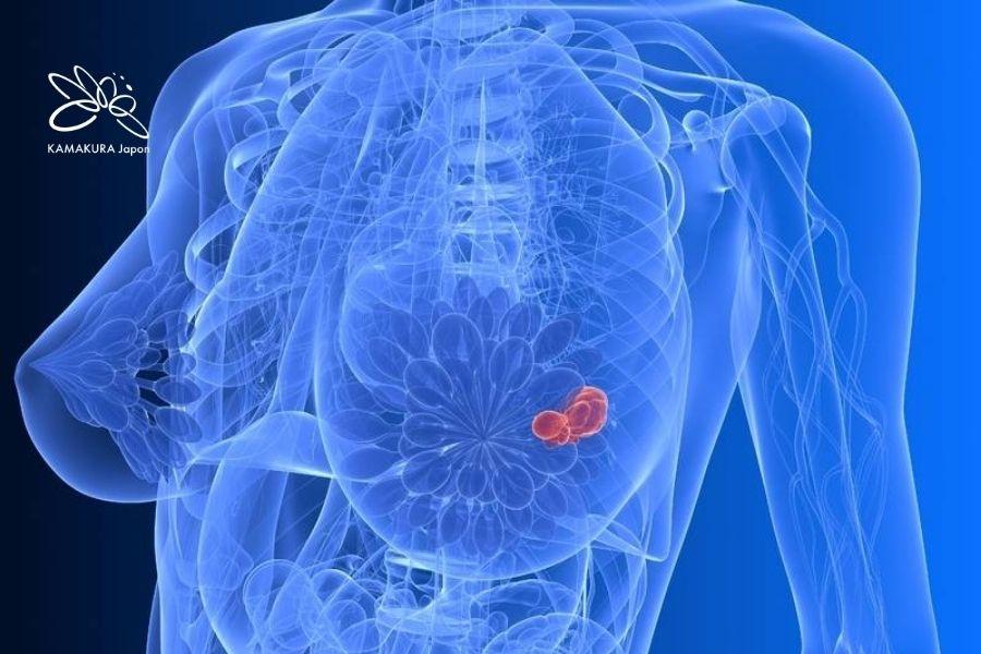 Trung tâm Ung thư vú của Juntendo cung cấp phác đồ điều trị toàn diện